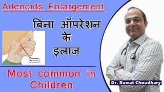 Adenoids Enlargement  Cure Without Operation  Most Common in Children [upl. by Ecreip37]