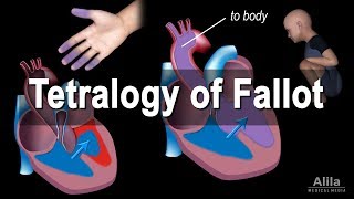 Congenital Heart Disease Tetralogy of Fallot Animation [upl. by Nylirehc798]