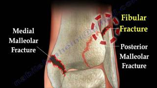 Ankle fracture  Fractures and its repair Everything You Need To Know  Dr Nabil Ebraheim [upl. by Callas163]