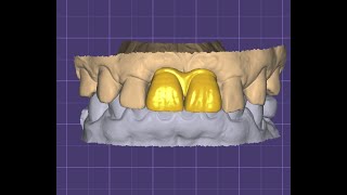 CADCAM Designing of upper anterior 11 21 for PMMA bridge  immediate loading implant [upl. by Xella327]