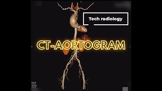 CTAORTOGRAM Ascending aorta dissection [upl. by Htebarual700]