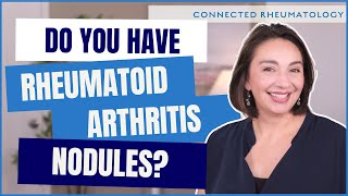 Surprise cause of Rheumatoid Arthritis nodules and everything else you need to know [upl. by Kirre]