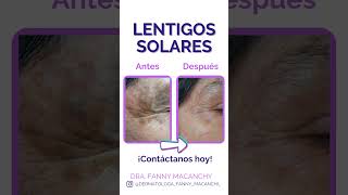 Lentigos solares [upl. by Noyahs]