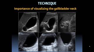 Basic Gallbladder [upl. by Nah]