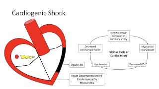 Cardiogenic Shock [upl. by Welton]