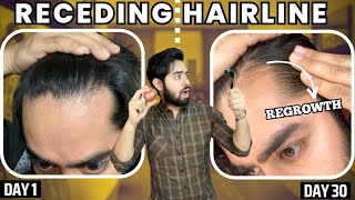 सिर्फ 1 महीने मैं RECEDING HAIRLINE REGROW करो  30 days HAIRLINE REGROWTH challenge [upl. by Drabeck]