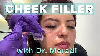 Watch This Patient Get Cheek Filler Before amp After Restylane Contour [upl. by Neall933]