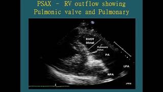 Normal Views  Transthoracic Echocardiogram TTE [upl. by Iluj653]