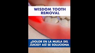 Por esto DUELE la MUELA del JUICIO y así se SACA  Pericoronaritis y extracción de los cordales © [upl. by Imelda85]