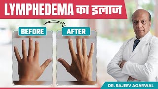 How to Manage Lymphedema Effective Treatment Options हिंदी में  Sentinel Lymph Node Biopsy [upl. by Notned]