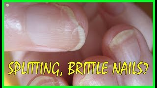 This Is Why Your Nails Keep Splitting  Brittle Nails Causes  Best Home Remedies [upl. by Ileane]