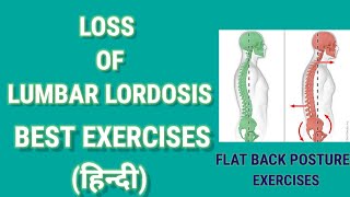 Loss of Lumbar Lordosis Exercises in Hindi  Flat Back Exercises  what is loss of lumbar lordosis [upl. by Nevad]