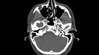 Fibrous Dysplasia Clivus [upl. by Corbet]