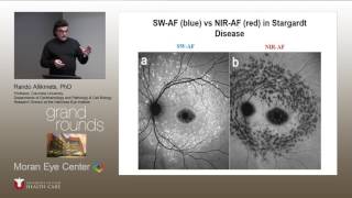 Clinical Spectrum of Stargardt and other ABCA4 Diseases [upl. by Ttiwed]