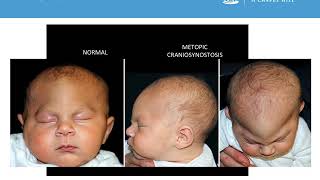 Neurosurgery Medical Student Primer  Craniosynostosis [upl. by Saloma]