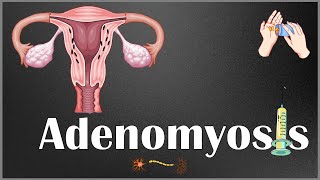 Adenomyosis  Definition Causes Risk Factors Signs amp Symptoms Diagnosis amp Treatment [upl. by Sabas]