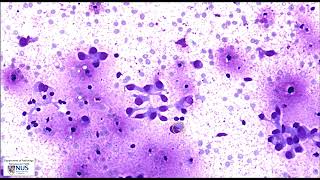 Cytology Thyroid nodule FNA  Metastatic breast carcinoma [upl. by Naras]