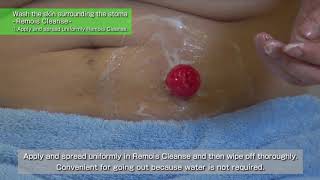 How to care and wash your peristomal area using Remois Cleanse [upl. by Lleret]