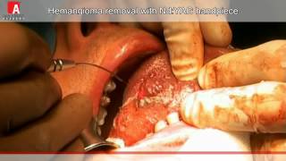 HEMANGIOMA REMOVAL Fotona Lightwalker NdYAG laser [upl. by Swirsky]