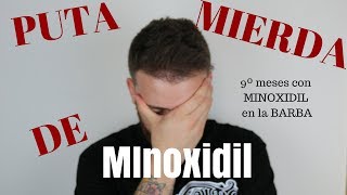 9º Meses con MINOXIDIL PUTA MIERDA DE MINOXIDIL [upl. by Ellehsal]