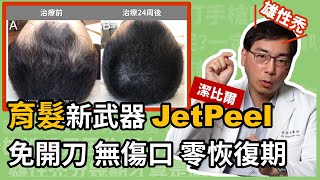 雄性禿育髮新武器「JetPeel 潔比爾」，林政賢院長親自體驗，免開刀、無傷口、無恢復期！ [upl. by Akehsal]