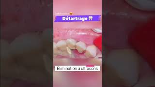 Détartrage dentaire à ultrasons 🦷shorts satisfying [upl. by Adieren]