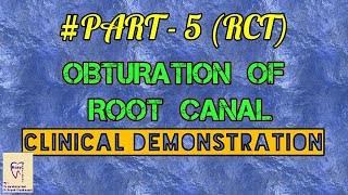 Obturation Of Root CanalsRCT [upl. by Atsirhc]