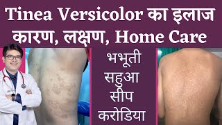 Tinea Versicolar Treatment  भभूतीसीपसहुआकरोडिया का इलाज  Pityriasis Versicolor  In Hindi [upl. by Ludovico]