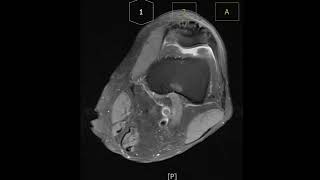 Prepatella bursitis with bursal wall thickening [upl. by Yeslaehc]