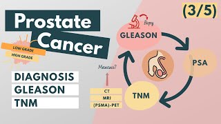 Prostate Cancer  Symptoms Diagnosis Staging Grading  Overview for Med Students [upl. by Trimmer676]