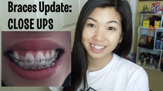 Braces Update  Longer springs and close ups 7 months [upl. by Orel98]