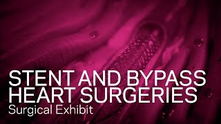 Stent Procedure and Cardiac Bypass Surgery Animation [upl. by Itirahc]