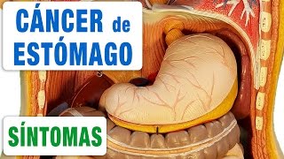 El Cáncer de Estómago y sus Síntomas ¿Cómo Sospechar que puedo tener un Cáncer de Estómago [upl. by Monah825]