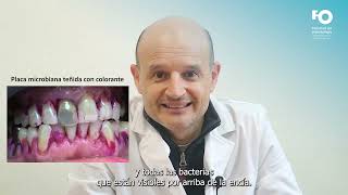 ¿Qué tratamiento debemos realizar en caso de padecer Periodontitis  Dr Ernesto [upl. by Gnes]