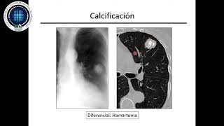 Adenocarcinoma Pulmonar  Dr Pedro Pablo Gonzalez [upl. by Dnomaid]