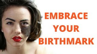 Why BIRTHMARKS do NOT need to be removed [upl. by Wahl]