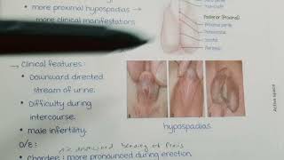 Hypospadias  Classification Features  Surgical Management  Surgery  FINAL YEAR MBBS [upl. by Adebayo]