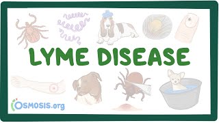 Lyme disease  causes symptoms diagnosis treatment pathology [upl. by Iaht754]