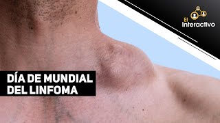 Linfoma causas síntomas y tratamiento [upl. by Acinimod]