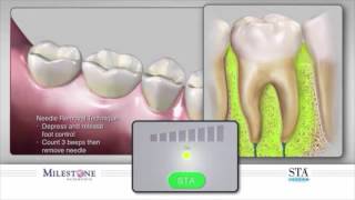 The Wand® STA Instrument  Intraligamentary PDL Injection [upl. by Schramke]