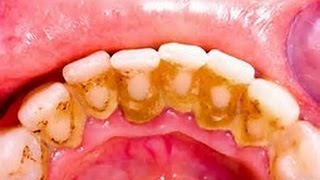 HOW TO REMOVE DENTAL PLAQUE IN 5 MINUTES NATURALLY WITHOUT GOING TO THE DENTIST [upl. by Chew369]