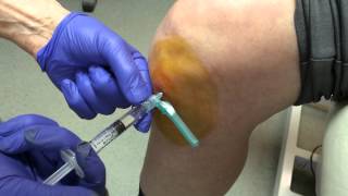 Norwich Podiatrist  Ostenil Plus injection of the knee  part 2 [upl. by Sordnaxela951]