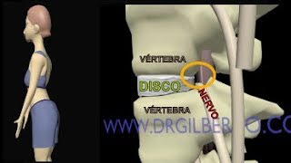 Hernia de Disco  Extrusão Discal  Protusão  Abalamento Dr Gilberto explica [upl. by Aiykan]