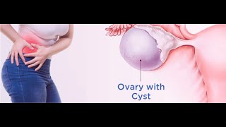 Ovarian Cyst Pain Treatment [upl. by Enelyar]