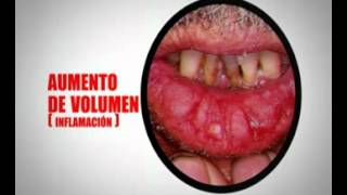 Queilitis Actínica [upl. by Aikam]