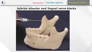 TECHNIQUES OF LOCAL ANESTHESIA [upl. by Dahsraf]