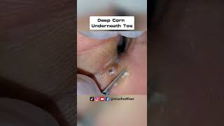 Deep Corn Underneath Toe  Satisfying Deep Corn Removal Full Treatment By Miss Foot Fixer [upl. by Anaujat]