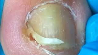 The ingrown toenail is a little inflamed be careful to separate the nail [upl. by Nadaha]