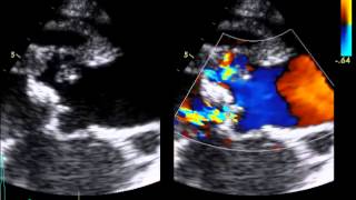 Infective Endocarditis  Aortic Root Abcess [upl. by Mchugh]