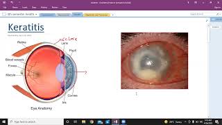 Keratitis  types of keratitis  Ophthalmology  USMLE step 1 [upl. by Oramug]